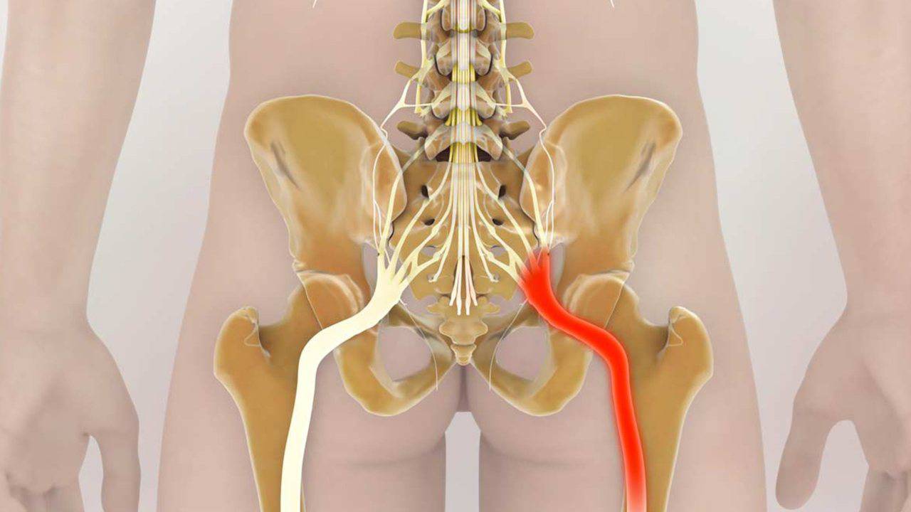 Nervo sciatico: 2 esercizi perfetti per combatterlo (DS cares)